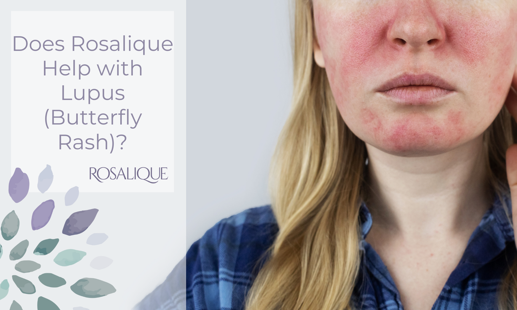 Does Rosalique help with lupus (butterfly rash)?