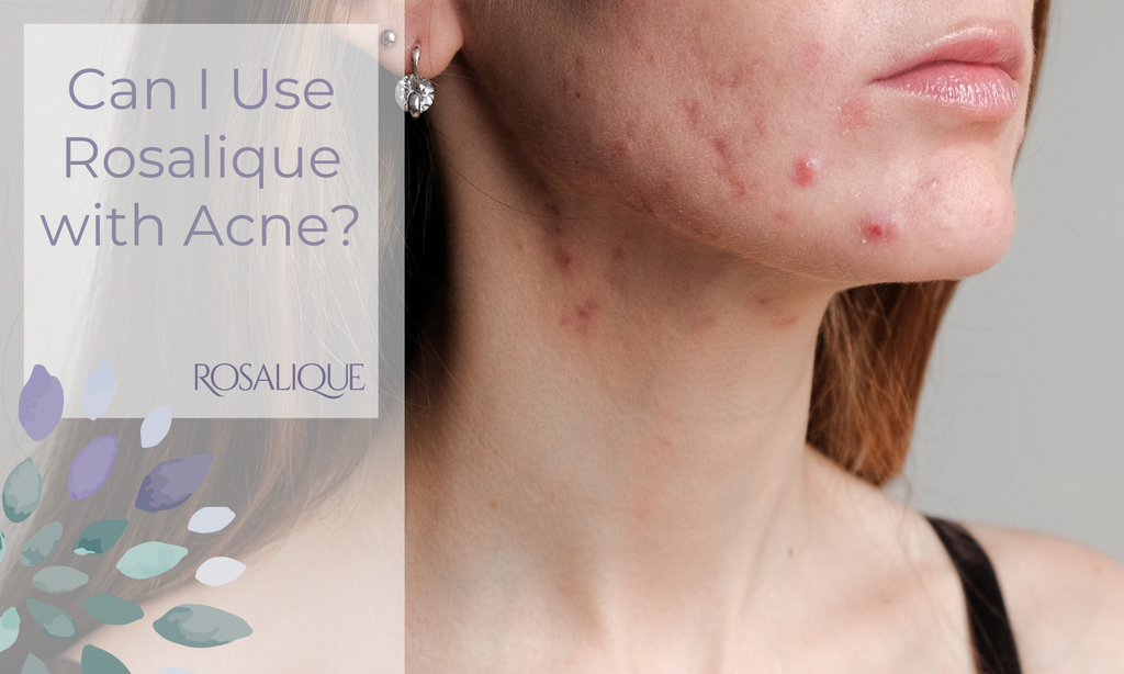 Can I use Rosalique with acne?