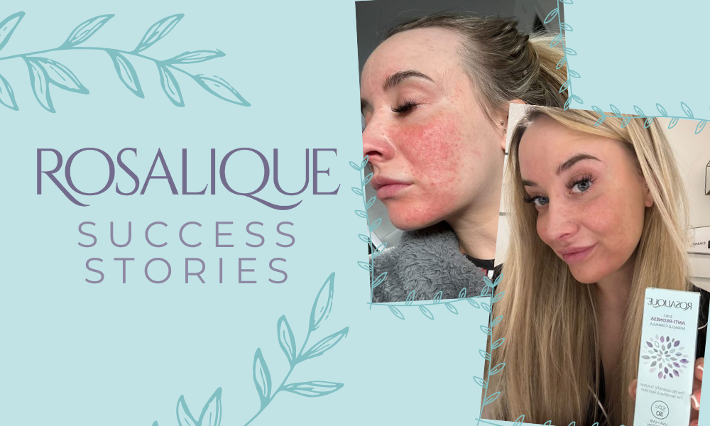 Learning About Rosacea - Success Stories