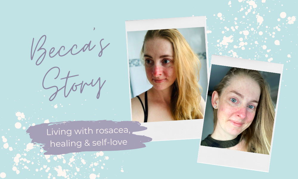 Rosacea, Healing & Self-Love – Becca's Story