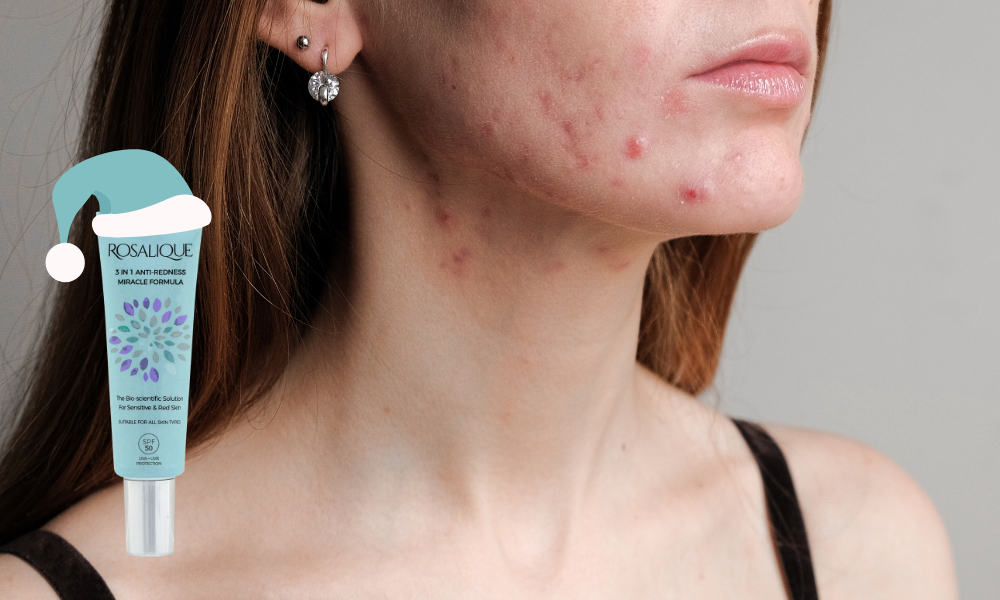 Looking After Your Congested Skin During The Holidays | Rosalique USA